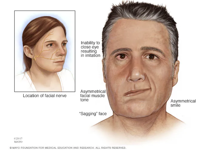 Bell’s Palsy